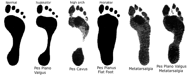 under pronation of foot